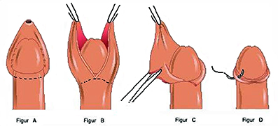 Penis omskåret Category:Low quality